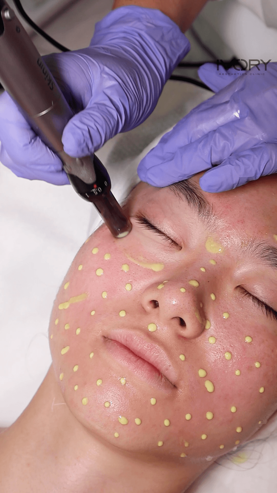 Medical microneedling treatment at Ivory Aesthetics Clinic