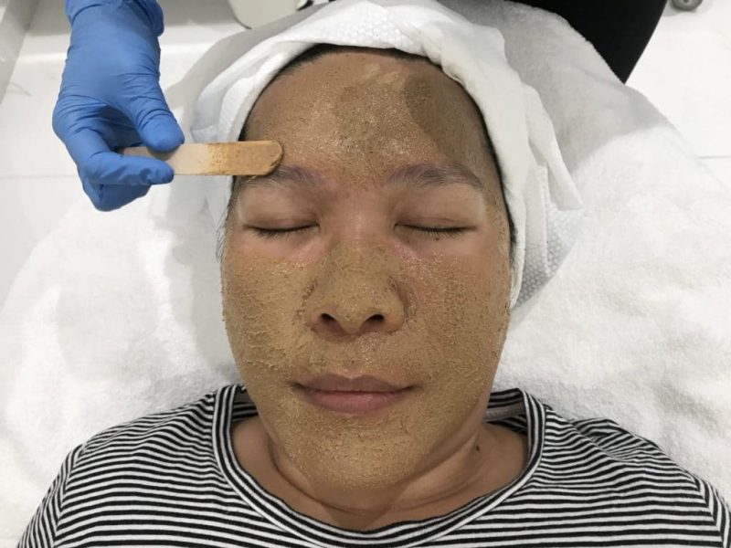 Cosmelan Peel Treatment 