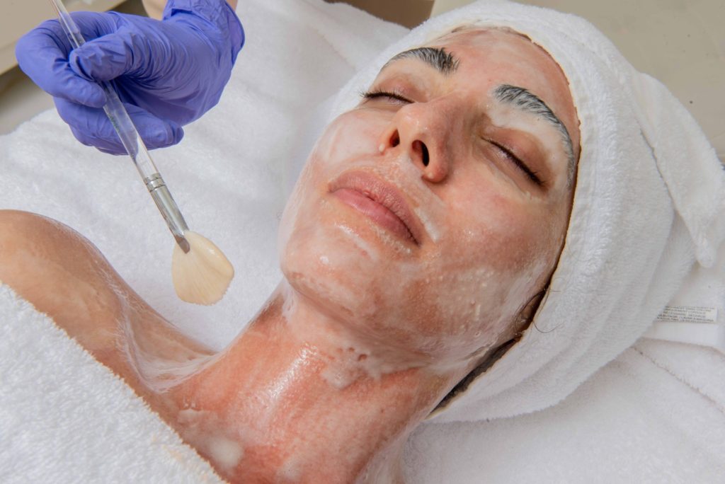 Glycolic acid and other chemical peels. Here’s what you should know!