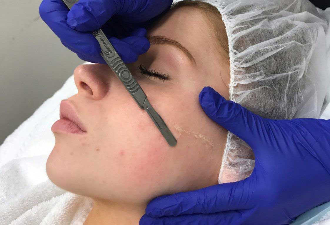 Dermaplaning – It’s More Than Just Shaving Your Face!
