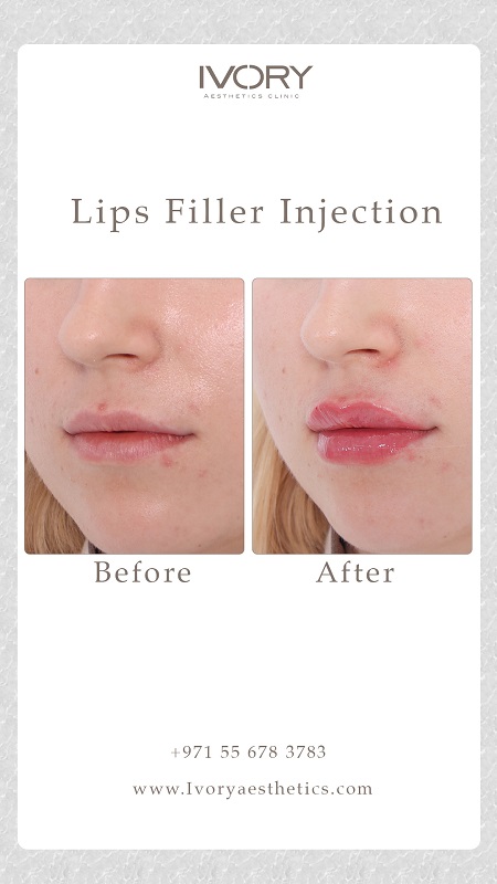 Benefits of Lip Enhancement