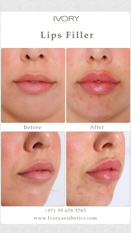 Who Can Benefit from Lip Enhancement?