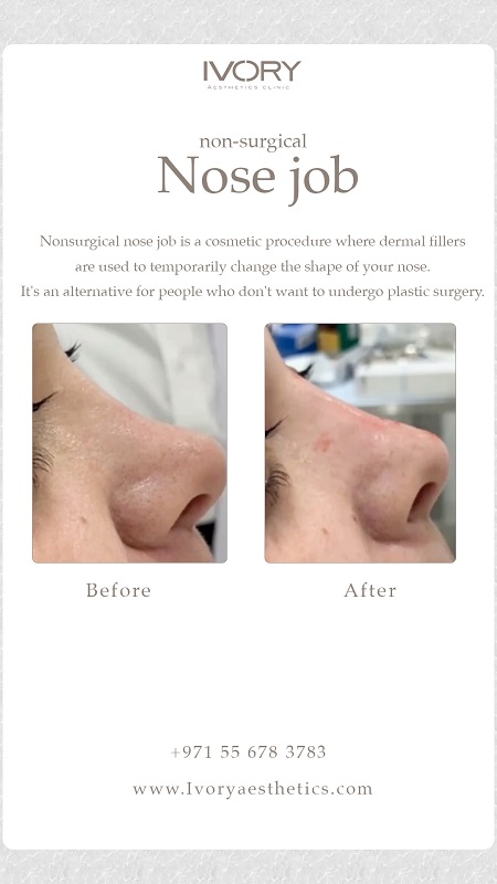 How Does a Non-Surgical Nose Job Work?