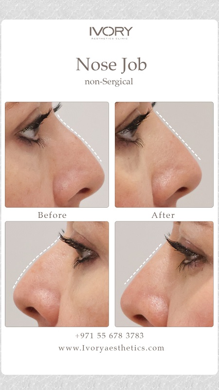 Key Benefits of a Non-Surgical Nose Job