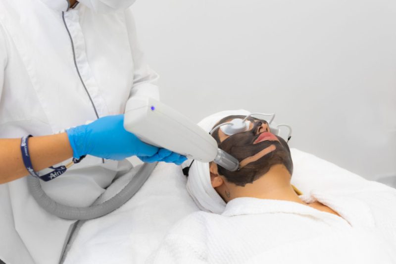 Carbon Laser Facial