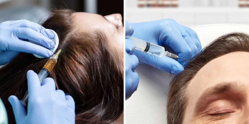 PRP Hair Treatment