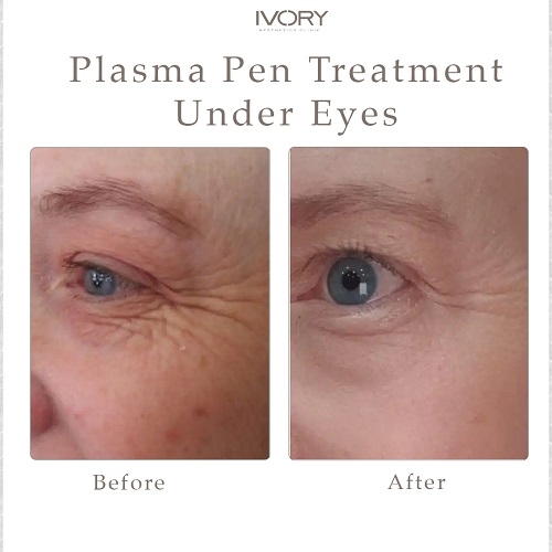 How Plasma Pen Skin Tightening Works