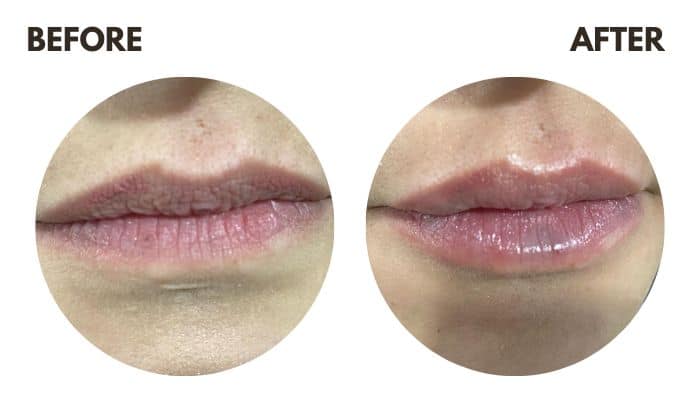Lip Enhancement- For a Pout That Counts