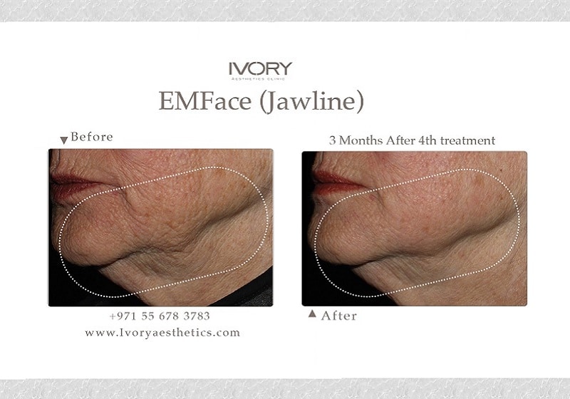 Emface before and after