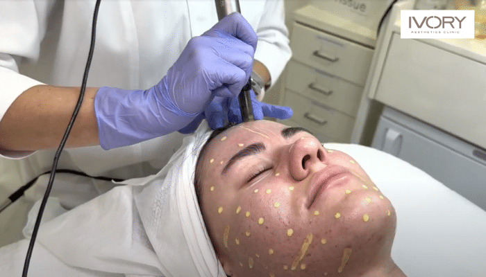 Medical Microneedling: Fight the First Signs of Aging