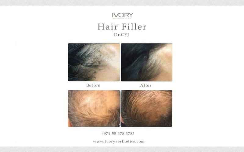 What Sets Hair Filler Apart?