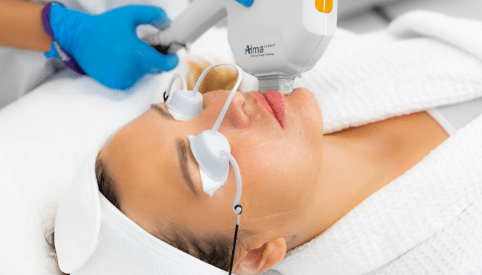 Say Goodbye to Face Pigmentation, Rosecea, and Age Spots with AFT Laser Treatment