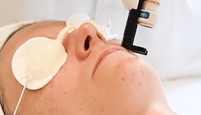Clearskin Laser Treatment: Safe and Effective Solution for Acne-Scarred Skin