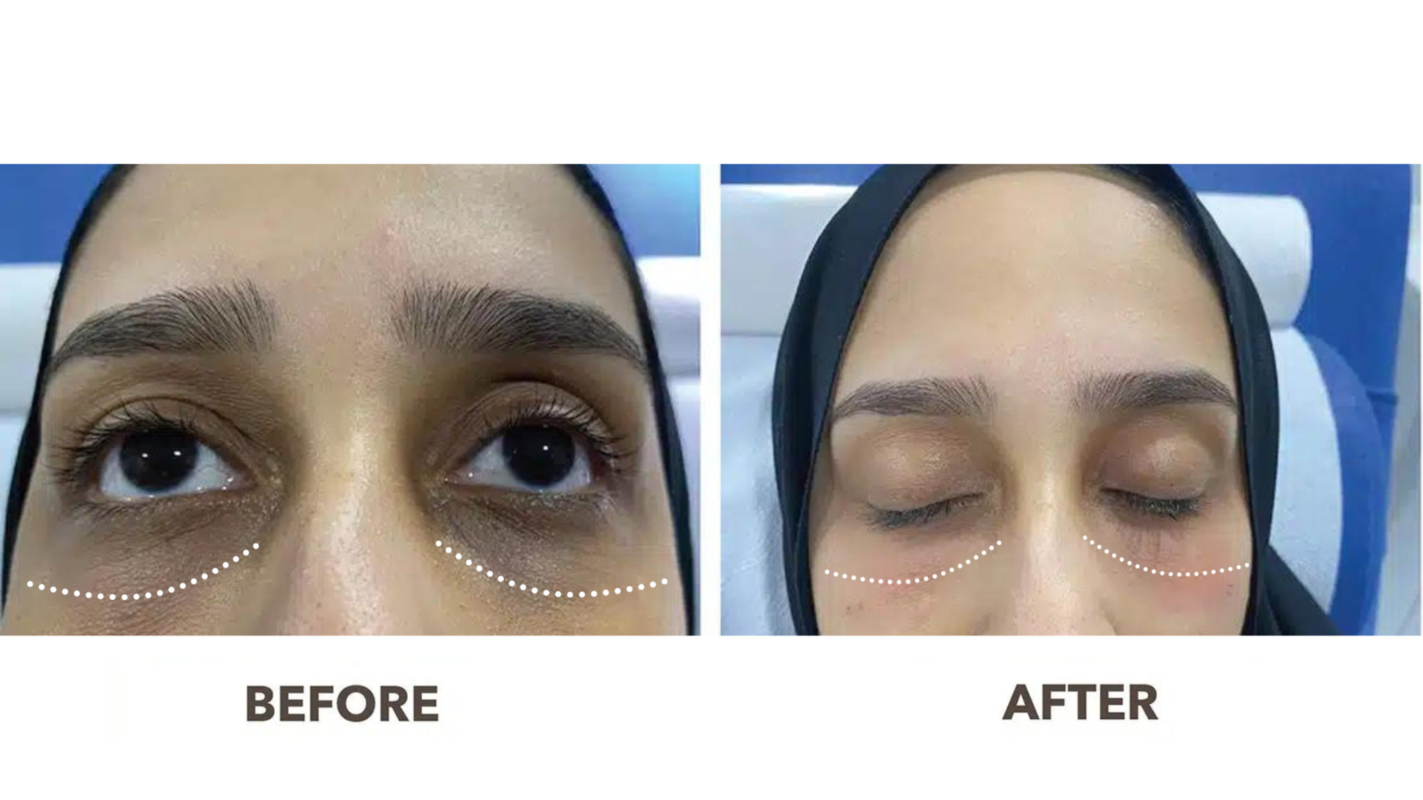 No More Baggage: The Transformative Power of Under-Eye Fillers