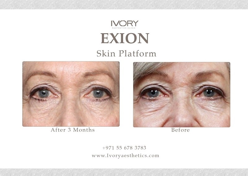 How RF Microneedling Fractional by Exion Works