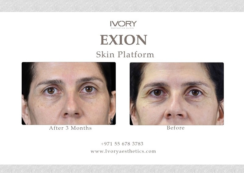 Key Benefits of RF Microneedling Fractional by Exion