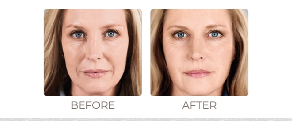 Sculpting Timeless Beauty with Sculptra