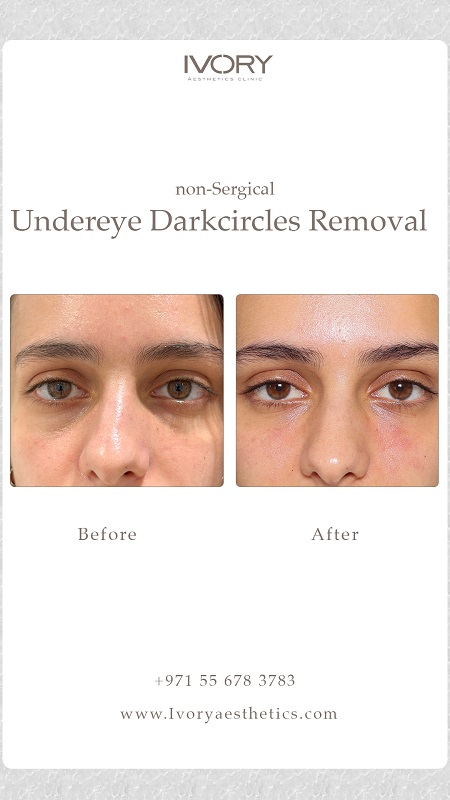 Dark Circles Treatment