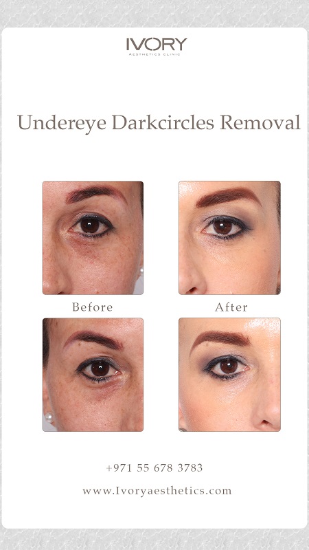 Aftercare and Results of Dark Circles Treatment