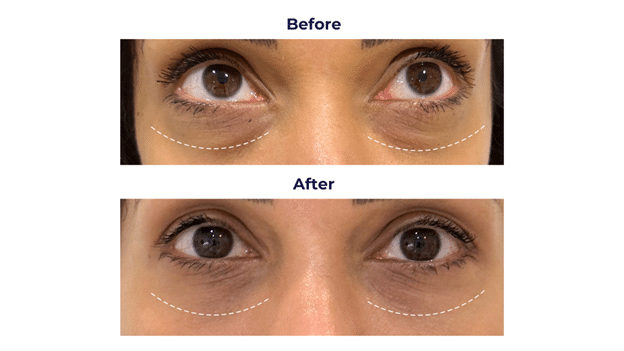 Effective Dark Circle Treatment That Actually Works