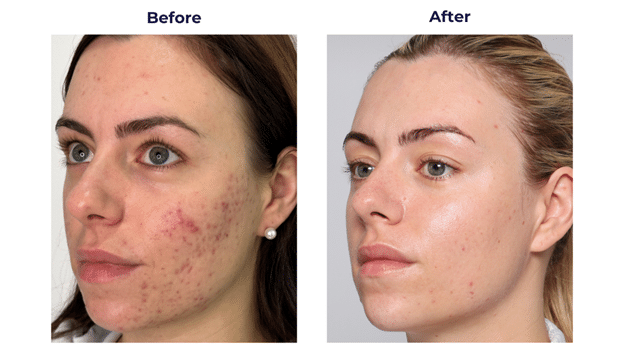 Clear Skin Laser Treatment: Achieve Radiant, Flawless Skin