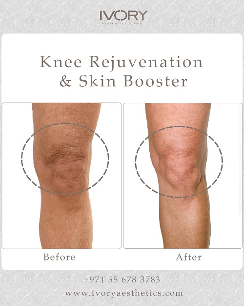 How Does Knee Rejuvenation Work?