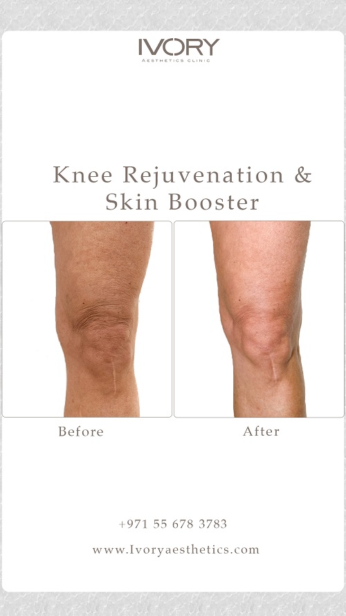 Knee Rejuvenation