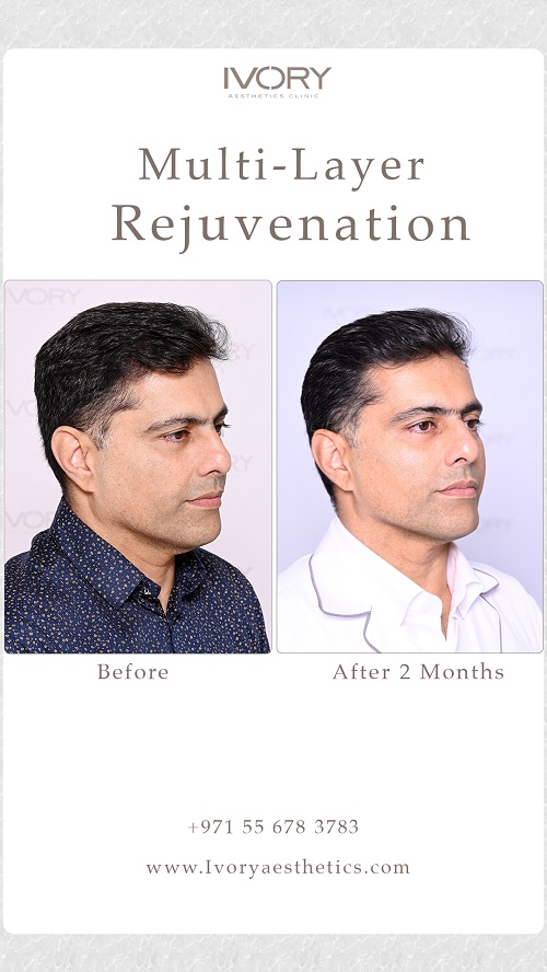 What is Multi-Layer Rejuvenation?