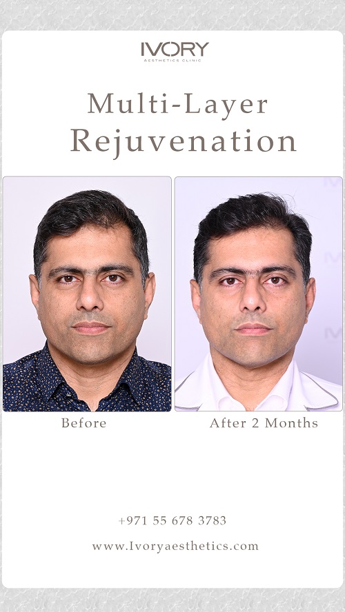 Multi Layer Rejuvenation