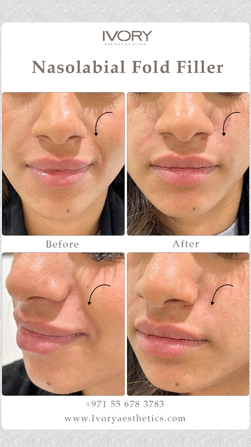 Benefits of Nasolabial Fold Fillers