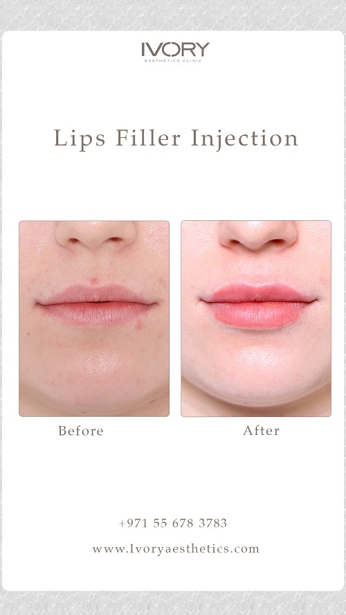 Benefits of Lip Fillers