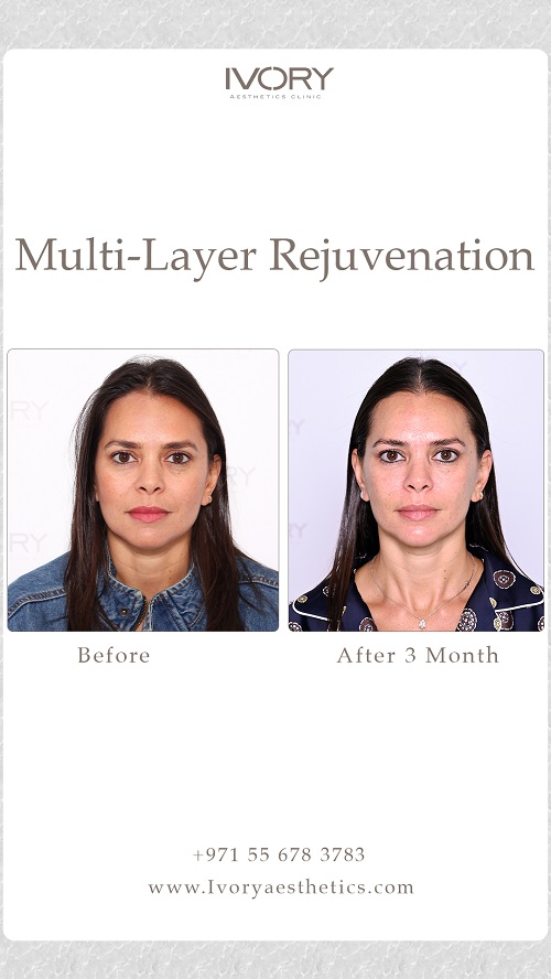 Benefits of Multi-Layer Rejuvenation