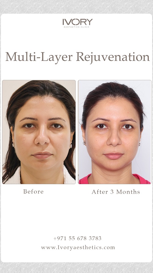 Key Components of Multi-Layer Rejuvenation